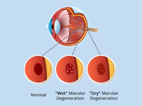 amd eye disease treatment.